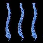 What Causes Cervical Spondylotic Myelopathy?